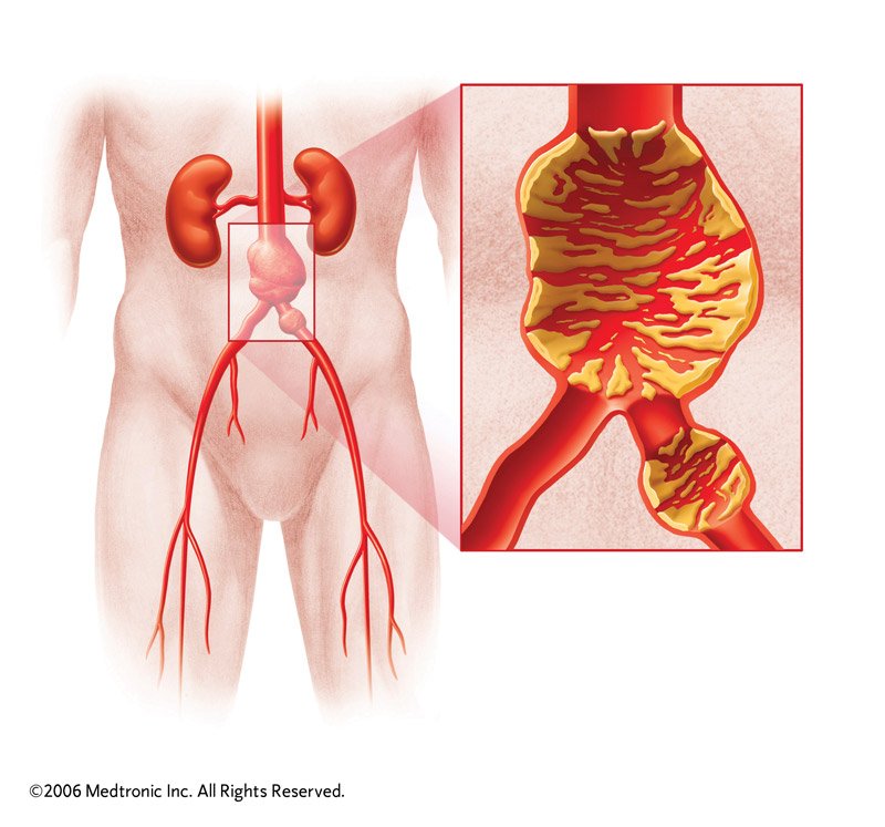 AAA risk factors