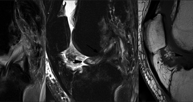 Arthrofibrosis