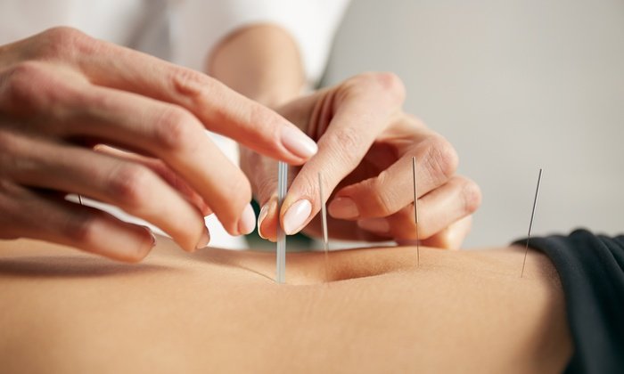 acupuncture treatment