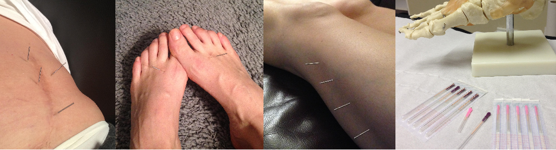 Acupuncture and dry needling